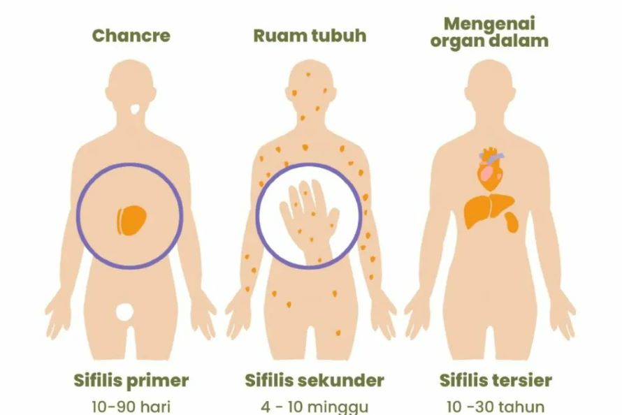 Tahapan sifilis (Sumber: Kemenkes)